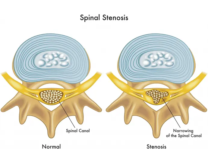 Kanal Daralması Spinal Stenoz Nedir?