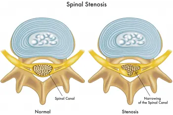 Kanal Daralması Spinal Stenoz Nedir?