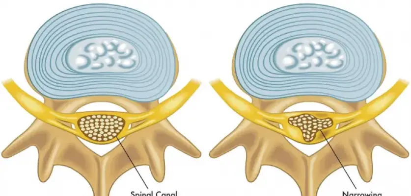 Kanal Daralması Spinal Stenoz Nedir?