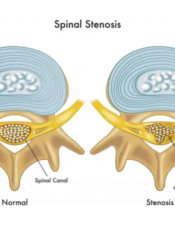Kanal Daralması Spinal Stenoz Nedir?